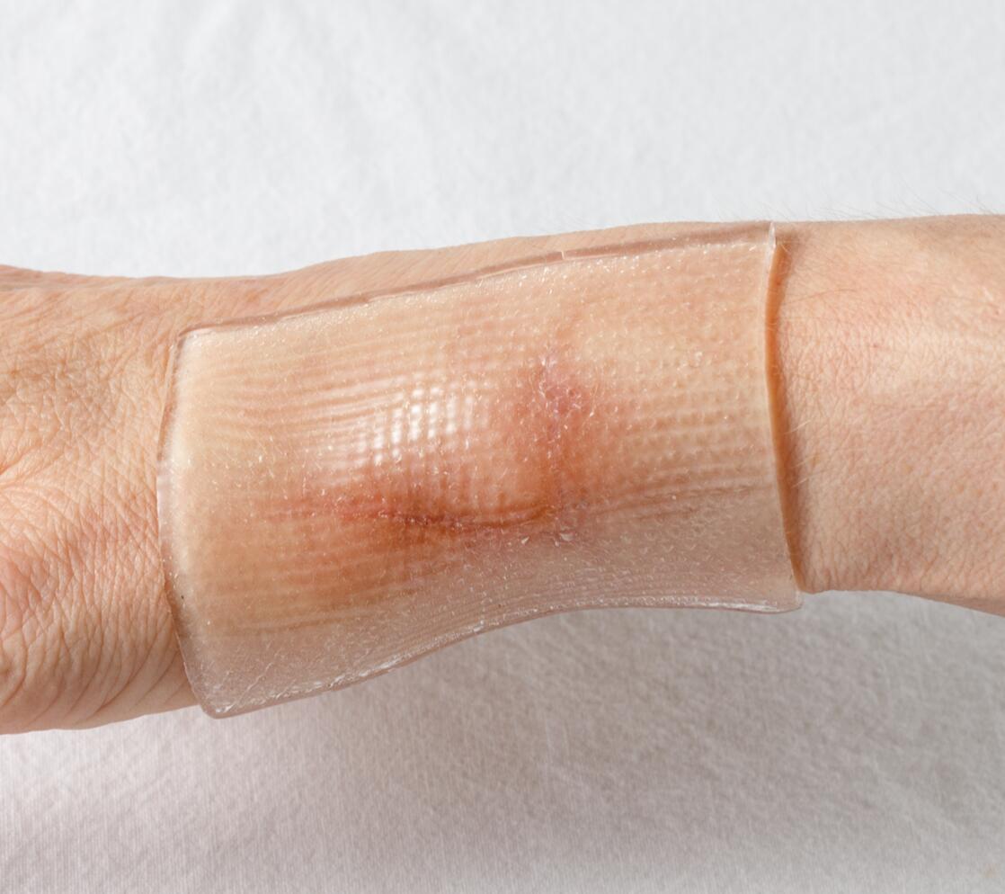 sideharso palovammalle